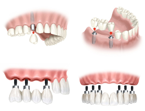 Trồng răng implant là gì? Ưu điểm của trồng răng implant