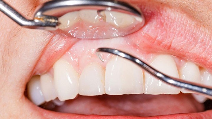Những Điều Bạn Cần Biết Trước Khi Thực Hiện Tẩy Trắng Răng
