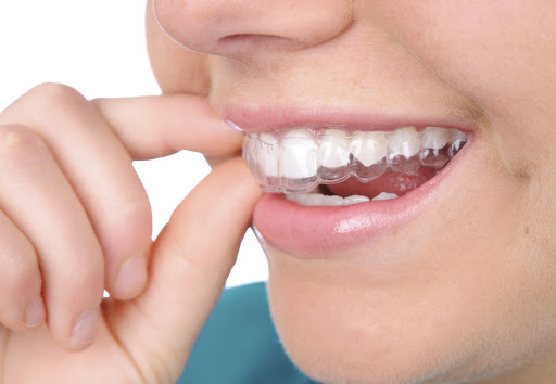 Niềng răng trong suốt Invisalign | Trung tâm niềng răng Ngọc Trai