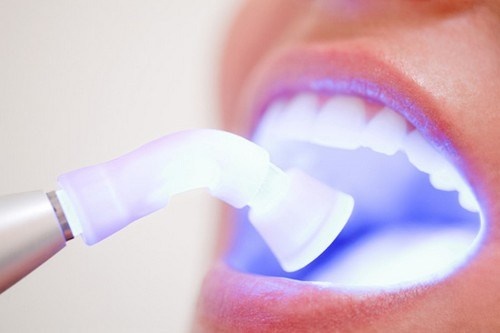 Tẩy Trắng Răng Là Gì? Nha Khoa Tẩy Trắng Răng Uy Tín Ở TpHCM