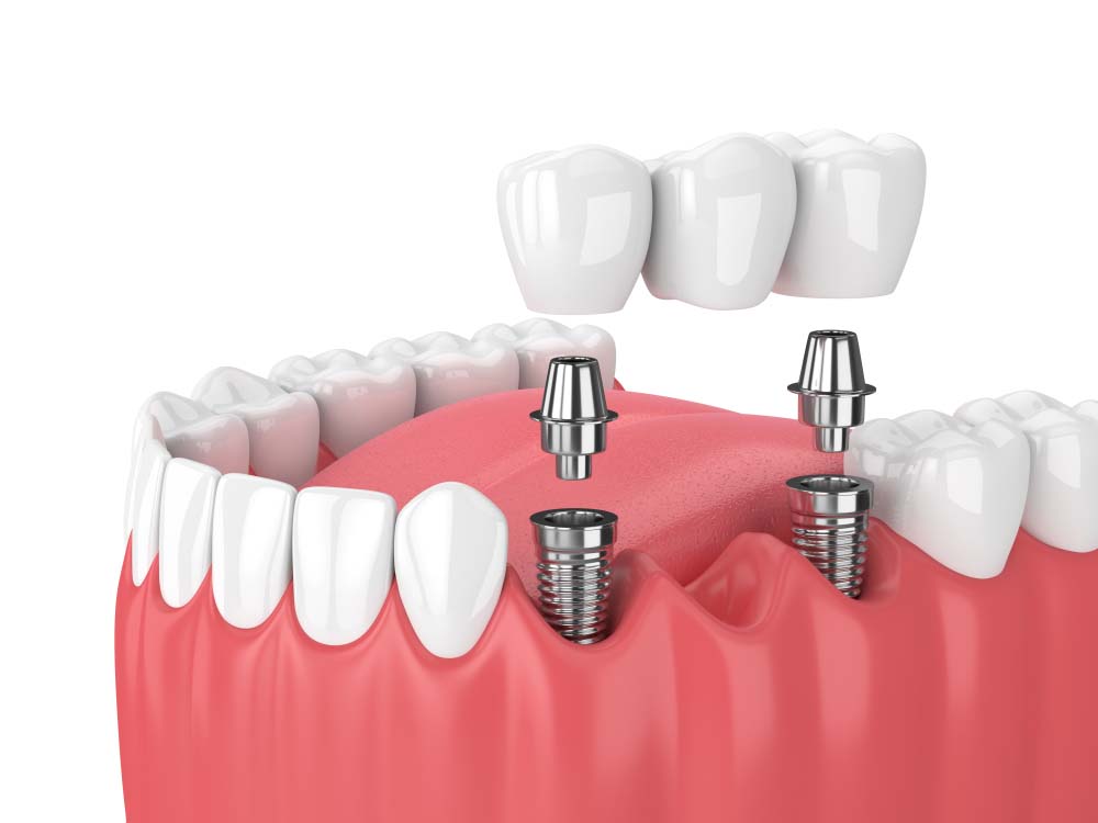 Trồng Răng Implant Là Gì? Ưu Điểm Của Trồng Răng implant