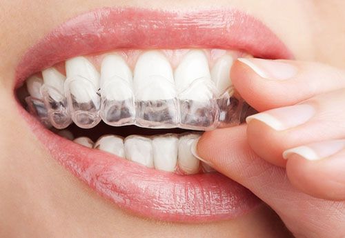 Niềng Răng Invisalign Và Những Điều Cần Biết Về Niềng Răng Không Mắc Cài