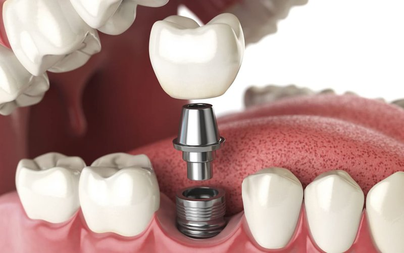 Cấy Ghép Implant Theo Tiêu Chuẩn Quốc Tế Dành Cho Người Mất Răng Lâu Năm