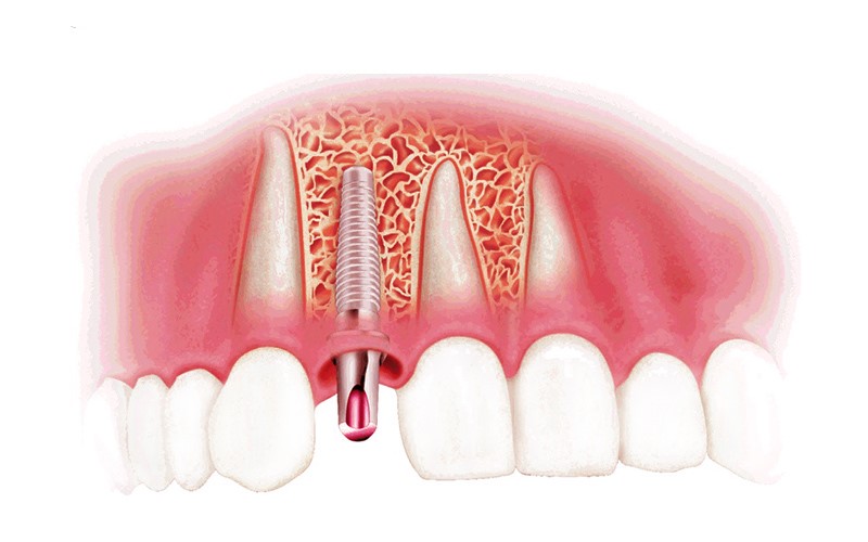 Tại Sao Cần Phải Trồng Răng Implant Khi Bị Mất Răng Vĩnh Viễn?