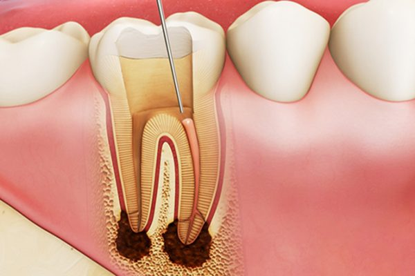 Điều Trị Tủy Răng Là Gì? Quy Trình Điều Trị Tủy Răng Hàm Không Đau Tại Nha Khoa Ngọc Trai