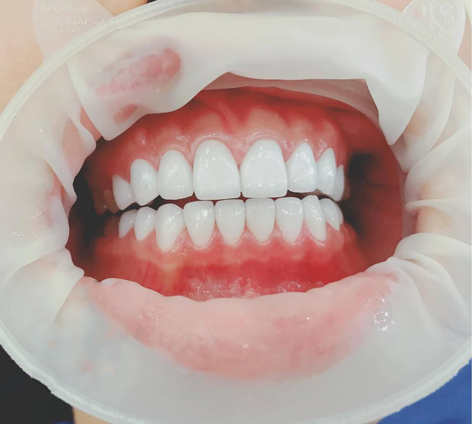 Mặt Dán Sứ Veneer | Giúp Răng Đẹp Hoàn Hảo – Nha Khoa Ngọc Trai