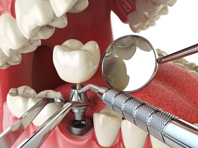Tìm Hiểu Về Quy Trình Phục Hình Răng Sứ Trên Răng Implant