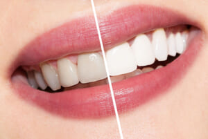 Tẩy Trắng Răng Là gì? Những Điều Cần Biết Về Tẩy Trắng Răng