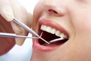 Tẩy Trắng Răng Là gì? Những Điều Cần Biết Về Tẩy Trắng Răng