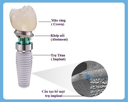 Tham Khảo Quy Trình Trồng Răng Implant
