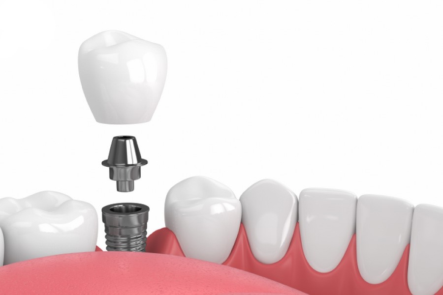 Chia Sẻ Cách Chăm Sóc Răng Miệng Khi Trồng Răng Implant Hiệu Quả