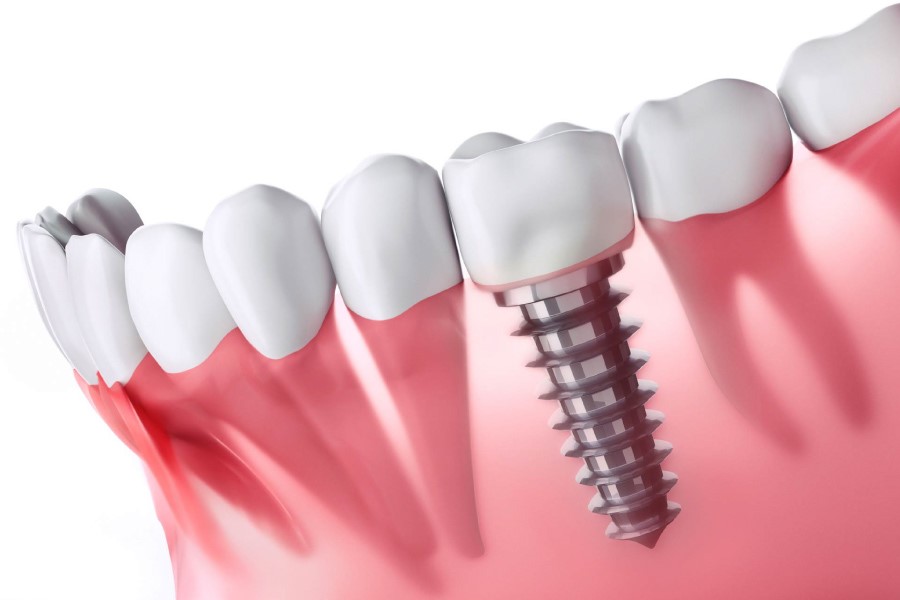 Nha khoa Ngọc Trai | Trồng Răng Implant Có Bền Hay Không?
