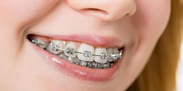 Niềng răng có đau không? Quá trình niền răng diễn ra như thế nào?