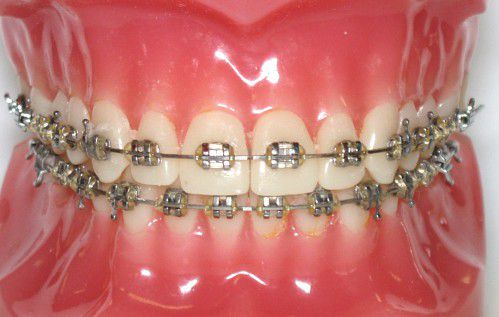 Niềng răng có đau không? Quá trình niền răng diễn ra như thế nào?