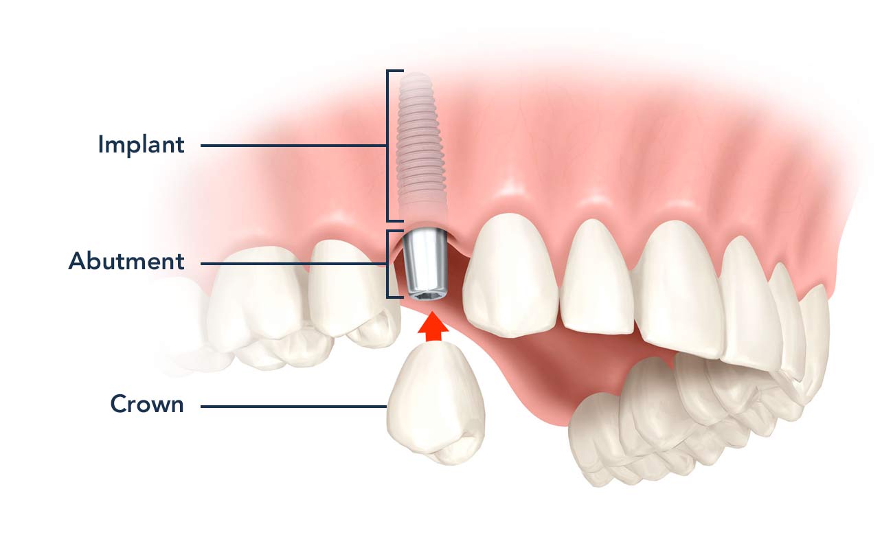 Implant Abutment Crown Image