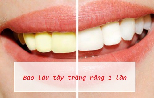 Bao Lau Tay Trang Rang 1 Lan 1