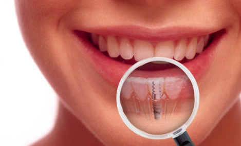 Những Phương Pháp Trồng Răng Giả & Những Điều Cần Lưu Ý Khi Trồng Răng