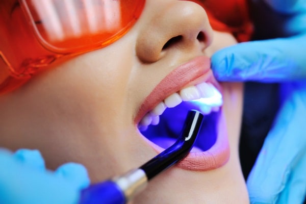 Bật mí các phương pháp tẩy trắng răng tốt nhất hiện nay