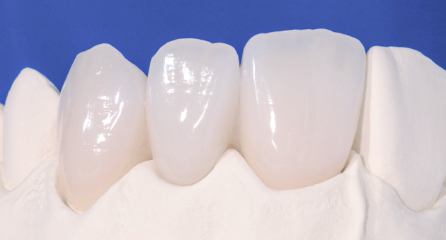 Bọc răng sứ mất thời gian bao lâu? Nha khoa bọc răng sứ uy tín
