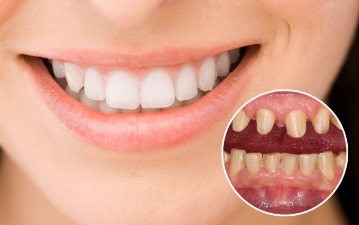 Bọc răng sứ thẩm mỹ là gì? Có nên bọc răng thẩm mỹ có nên hay không?