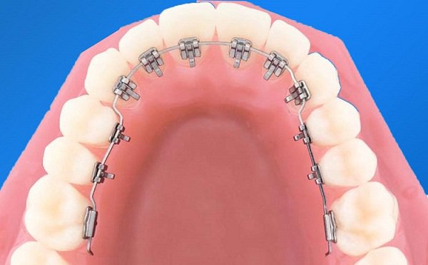 Các lý do để niềng răng - Địa chỉ niềng răng uy tín tại HCM