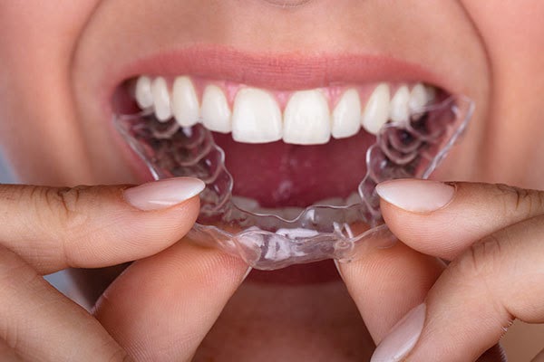 Các lý do để niềng răng - Địa chỉ niềng răng uy tín tại HCM