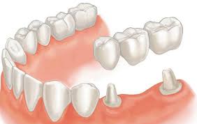 Các phương pháp làm răng giả phổ biến nhất hiện nay
