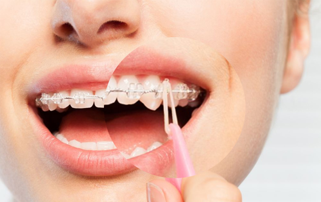 Chảy máu khi niềng răng | Nguyên nhân gây nên tình trạng này