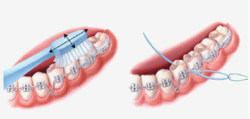 Chăm sóc và vệ sinh răng miệng khi niềng răng như thế nào?