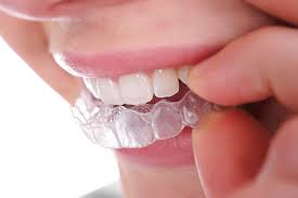 Chia sẻ 2 phương pháp tẩy trắng răng hiệu quả nhất hiện nay