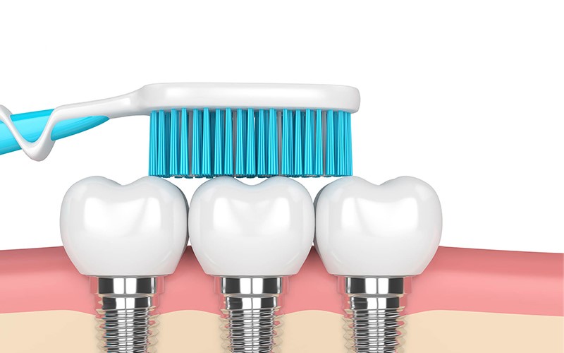 Chia sẻ cách chăm sóc răng miệng khi trồng răng implant hiệu quả