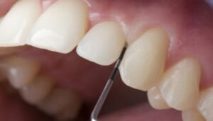 Chúng Ta Nên Tẩy Trắng Răng Tại Nhà Hay Đến Nha Khoa Uy Tín Để Tẩy Trắng Răng?
