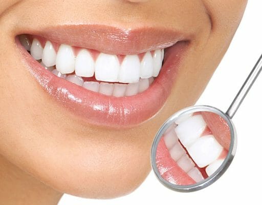 Đang niềng răng nhưng muốn trắng răng thì làm thế nào?