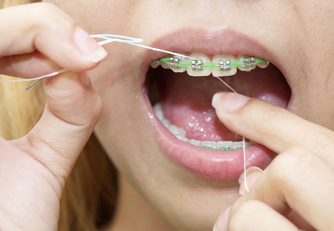 Đâu là những dụng cụ không thể thiếu khi niềng răng?