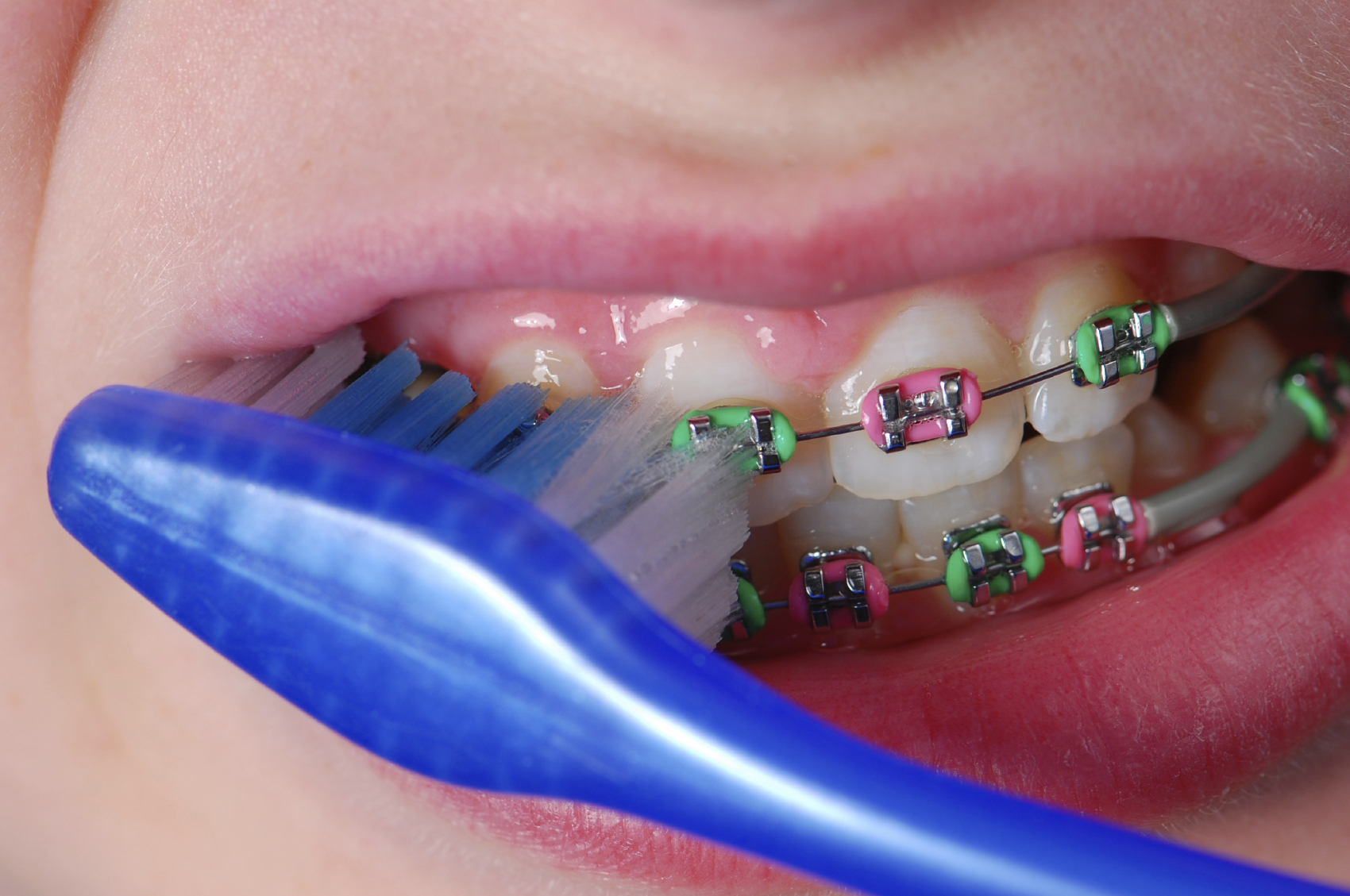 Đâu là những dụng cụ không thể thiếu khi niềng răng?