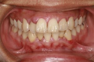 Nha khoa Ngọc Trai | Bị sâu răng ảnh hưởng đến sức khỏe như thế nào?