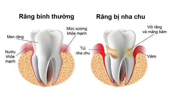 Nha khoa Ngọc Trai | Các phương pháp phục hình răng bị gãy tốt nhất