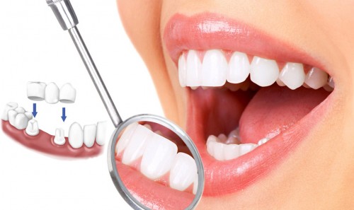 Nha khoa Ngọc Trai | Cần ăn gì và kiêng gì sau khi bọc răng sứ thẩm mỹ?