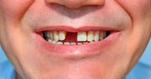 Nha khoa Ngọc Trai | Đâu là giải pháp cho người bị mất răng cửa?