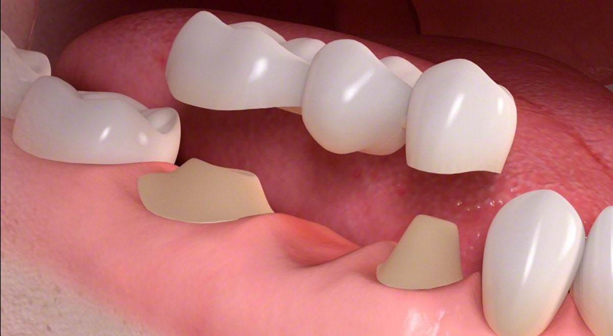 Nha khoa Ngọc Trai | Làm cầu răng sứ có bền hay không?