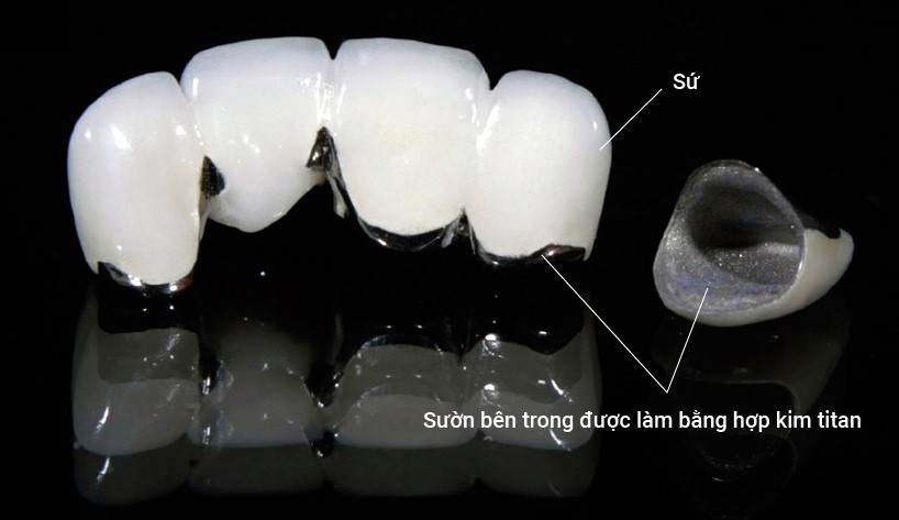 Nha khoa Ngọc Trai | Làm răng sứ lần 2 có đau không?