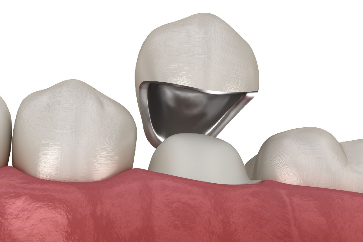 Nha khoa Ngọc Trai | Muốn bọc sứ răng mọc lộn xộn có được không?