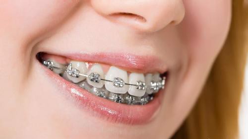 Nha khoa Ngọc Trai | Muốn bọc sứ răng mọc lộn xộn có được không?