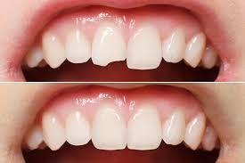 Nha Khoa Ngọc Trai | Răng bọc sứ rồi thì có thể trám răng được không?