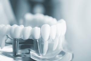 Nha Khoa Ngọc Trai | Răng bọc sứ rồi thì có thể trám răng được không?