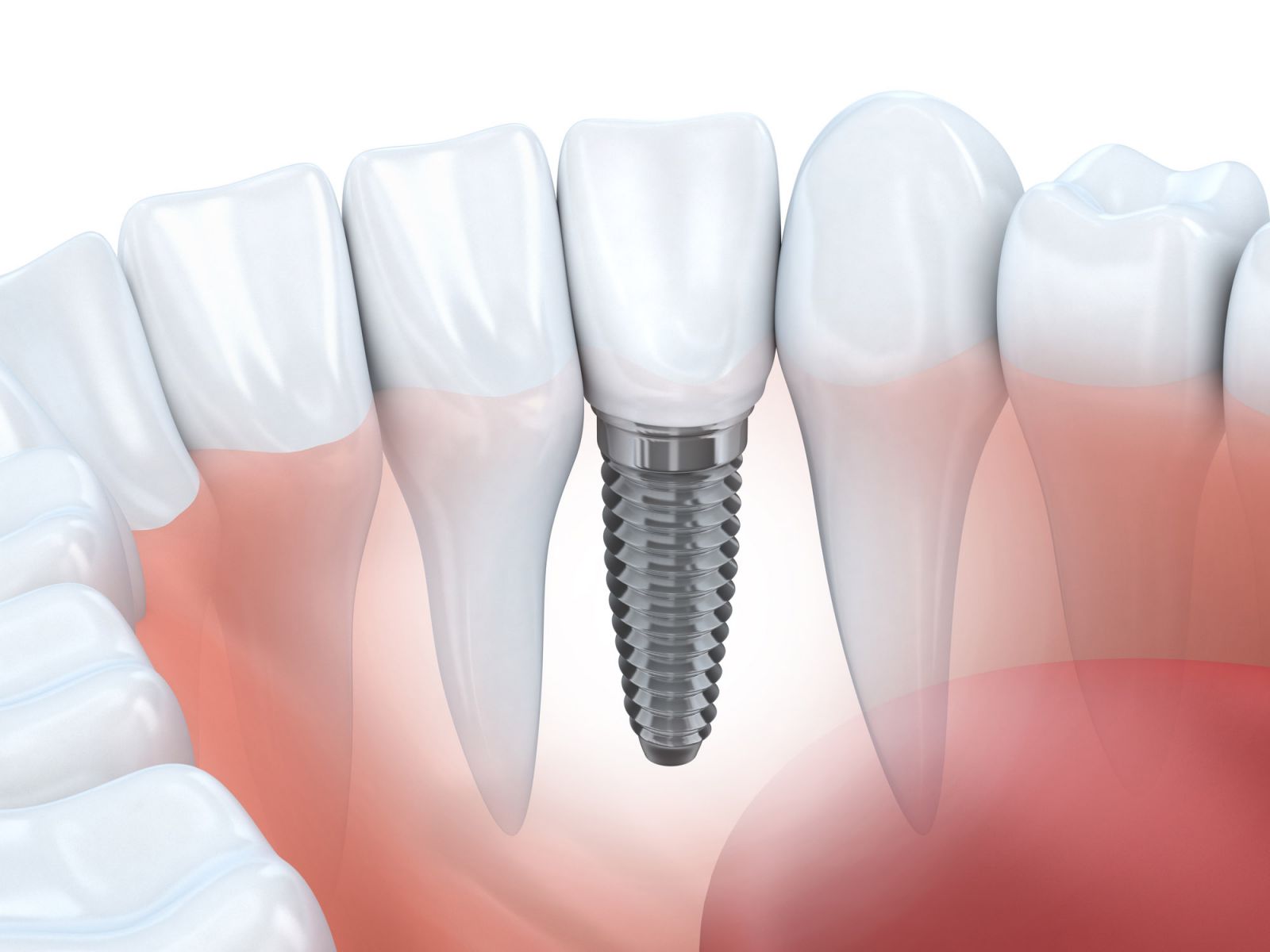 Nha khoa Ngọc Trai | Trồng răng giả cố định có bị đau hay không?