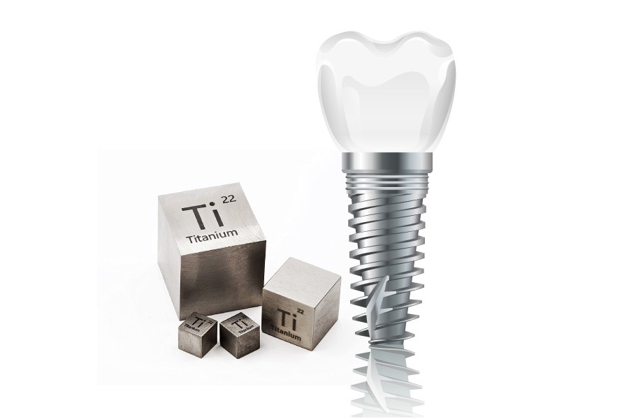 Nha khoa Ngọc Trai | Trồng răng implant có bền hay không?