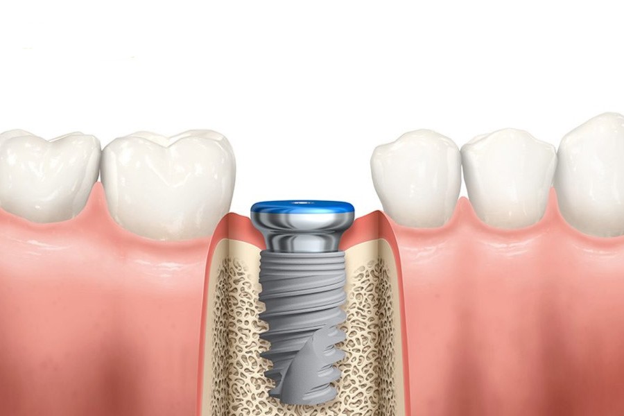 Nha khoa Ngọc Trai | Trồng răng implant có bền hay không?