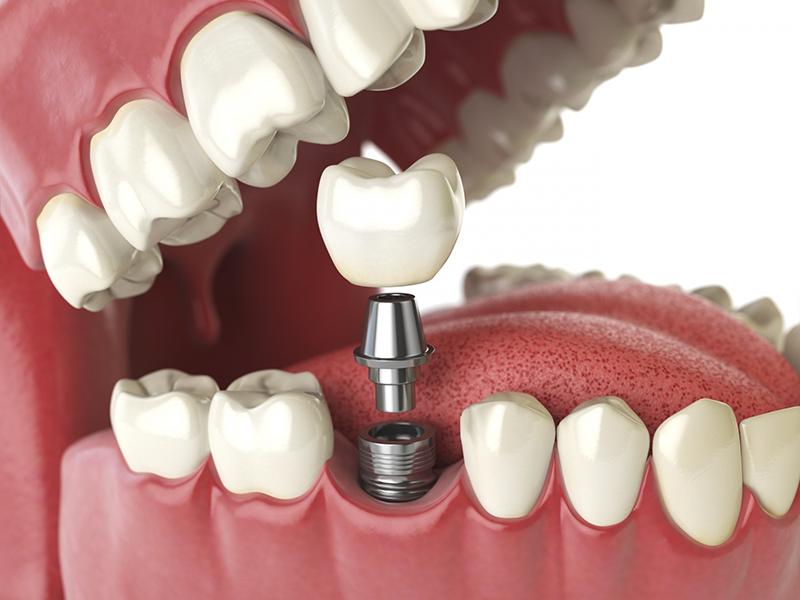 Nha khoa Ngọc Trai | Trồng răng implant giá rẻ có an toàn không?