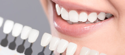 Những điều bạn cần biết về bọc răng sứ thẩm mỹ